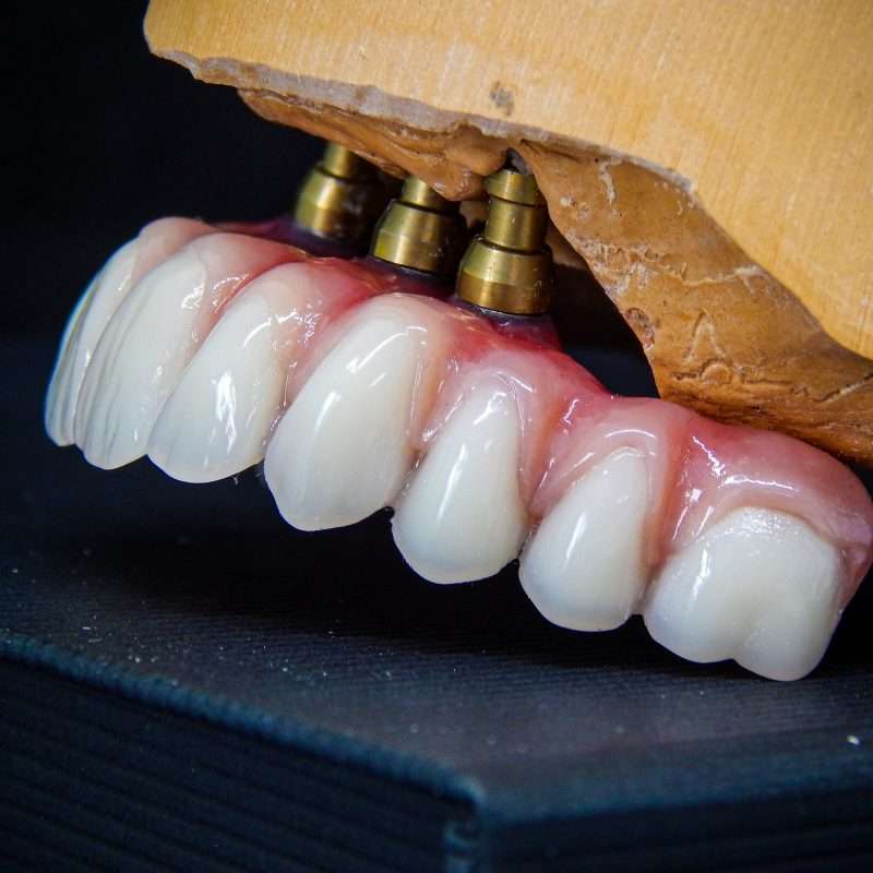 Implant supported bridges